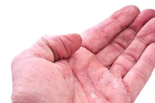 手部濕疹是什么原因引起的