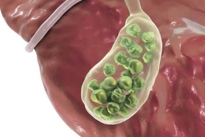 得了膽結(jié)石不能吃什么食物 膽結(jié)石飲食需要注意什