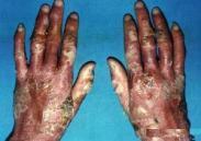 大皰性表皮松解癥