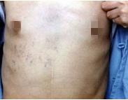 胸廓出口綜合癥