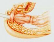 肛管、直腸、結腸狹窄