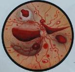 結締組織性腸炎