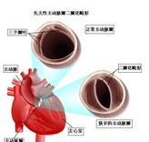 先天性二尖瓣畸形
