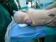 第Ⅱ、Ⅲ型脊髓血管畸形