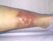 小兒結(jié)節(jié)性脂膜炎