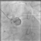 腎動(dòng)脈閉塞