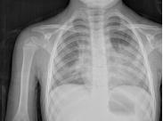 小兒支原體肺炎