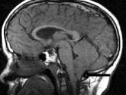 小兒高免疫球蛋白E綜合征