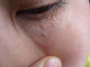 生乳頭汗管囊腺瘤