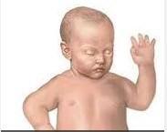 先天性腹壁肌肉發育不良