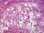 顆粒細(xì)胞瘤