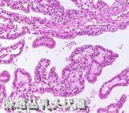 小兒脈絡(luò)叢乳頭狀瘤