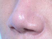 鼻/鼻型T/NK細胞淋巴瘤