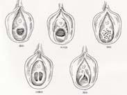 處女膜修補術(shù)