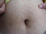 老年人神經梅毒