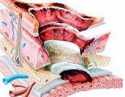 無機堿皮膚損傷