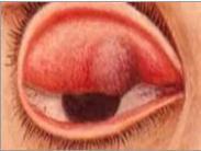 銅綠假單胞菌性角膜炎