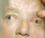 內分泌性眼球突出