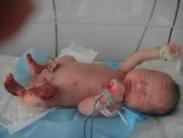 DF-2敗血癥的皮膚表現(xiàn)