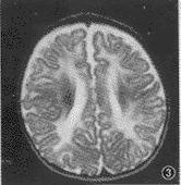 胼胝體進行性變性