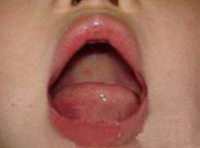 小兒埃可及柯薩奇病毒感染