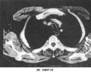 復(fù)發(fā)性多軟骨炎