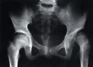髖關(guān)節(jié)前脫位