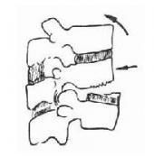 髂骨取骨后盆側腹壁疝