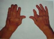 老年人類(lèi)風(fēng)濕性關(guān)節(jié)炎