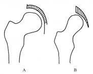 進行性骨干發育不良