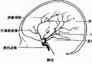 外傷后頸內(nèi)動(dòng)脈閉塞