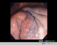 膽囊平滑肌肉瘤