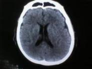 老年人腔隙性腦梗死