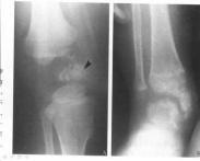 骨骺點狀發育不良