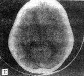 小兒球形細(xì)胞腦白質(zhì)營(yíng)養(yǎng)不良