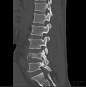 胸、腰椎爆裂骨折