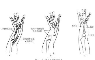 先天性尺骨缺如