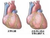 心尖肥厚型心肌病